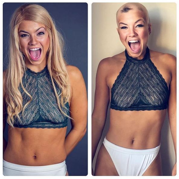 Christie Valdiserri suffered from alopecia