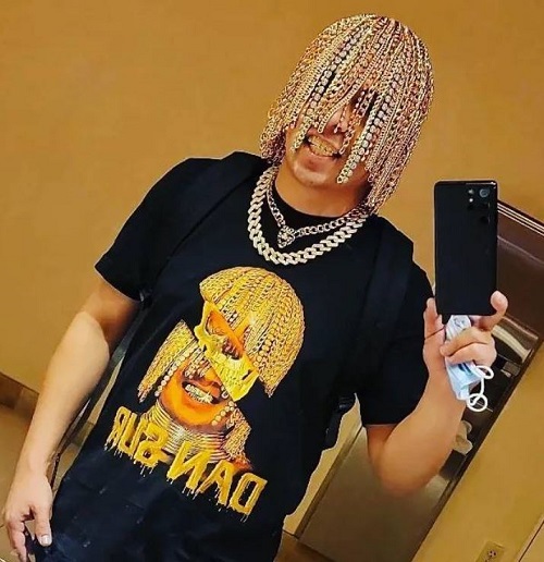 Dan Sur got gold chain scalp implant surgery in September 2021