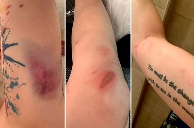 Kristin Evans ex lover Zac Stacy brutally beat her in front of their child (Kristin Evans' Injuries)