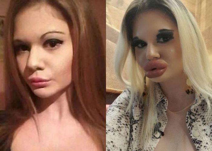 Andrea Ivanova before and after surgery