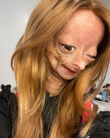Adalia Rose died at the age of 15