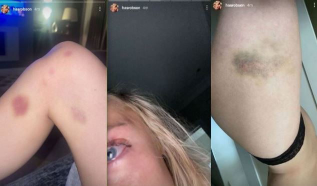 Harriet Robson was physical assualted by her former boyfriend Mason Greenwood