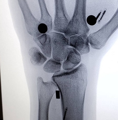 Anastasia Synn magnetic implants in hands