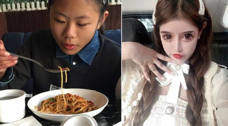 Zhou Chuna before and after surgery photo