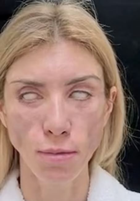Yulia Tarasevich was unable to close her eyes or smile after a botched cosmetic procedure