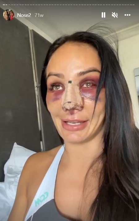 Hayley Vernon rhinoplasty surgery