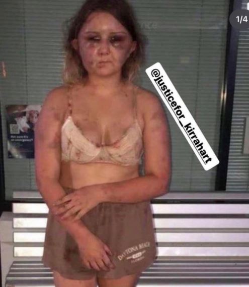 A photo of Kirra Hart after attack
