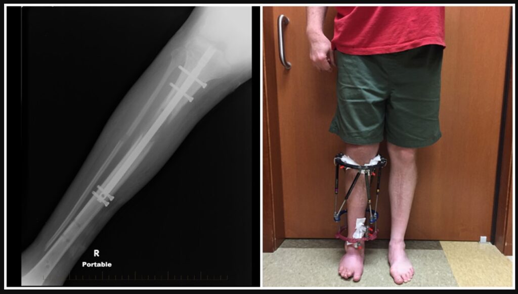 Leg-lengthening The people having surgery to be a bit taller